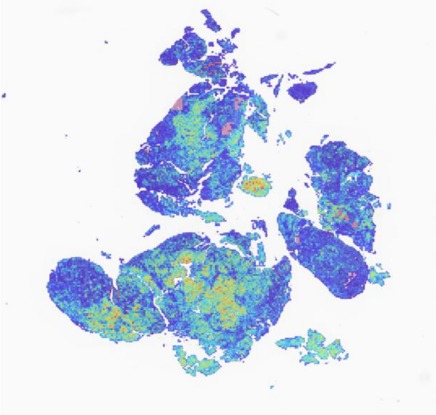 Biopsia digitalizada con mapa de calor generado por inteligencia artificial.